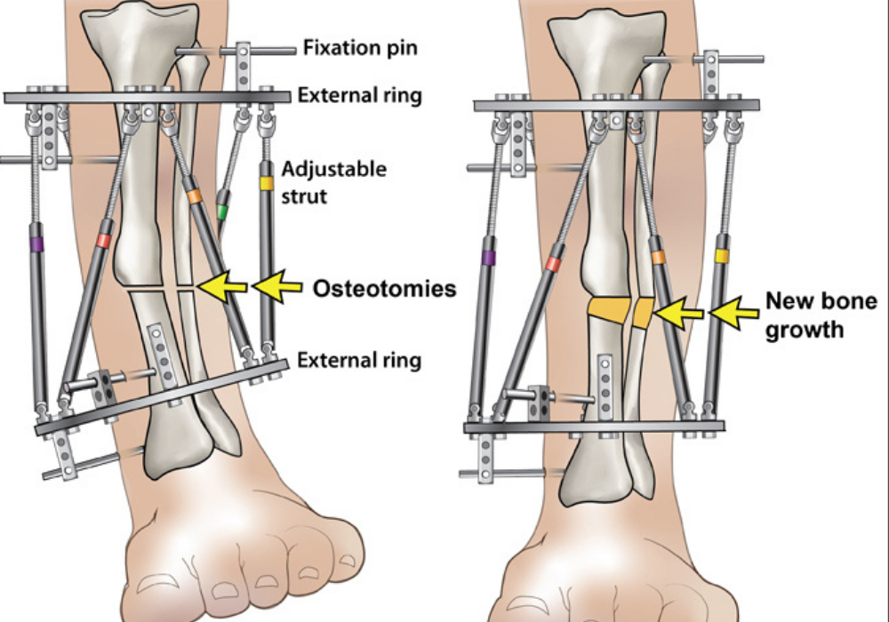 paediatric orthopaedicss procedure image