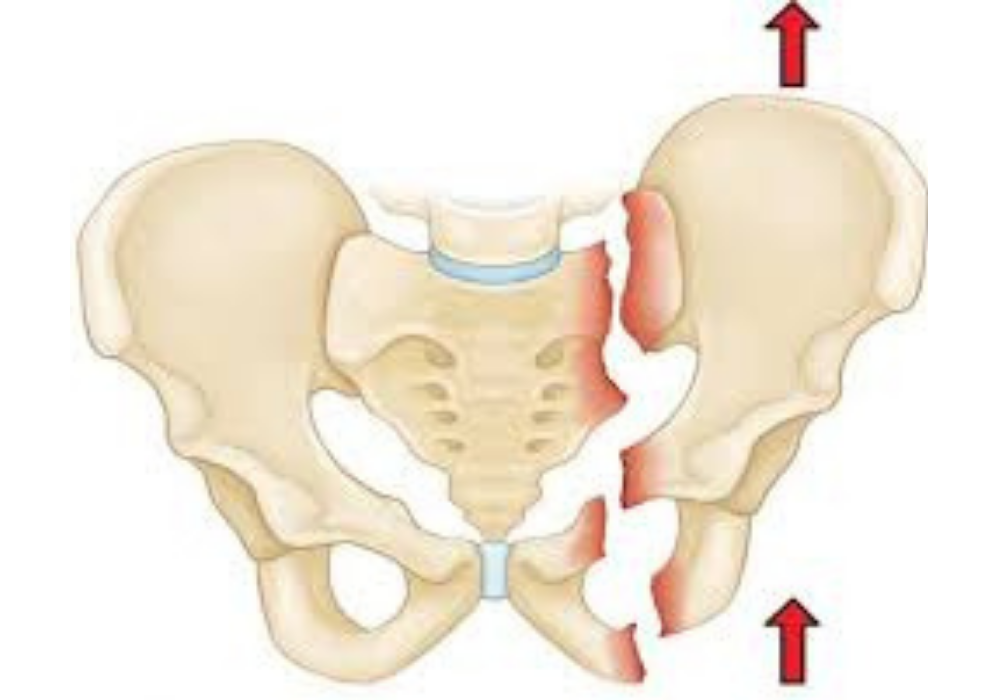 Pelvic and Acetabulum image @Dr DP Sharma