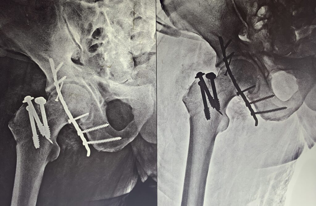 pelvic-and-acetabular x-ray image